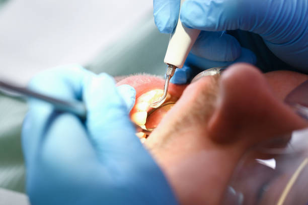 Best Emergency Dentist for Lost Fillings or Crowns in Bryn Mawr Skyy, WA